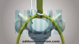 Lumbar Microdiscectomy surgery animation