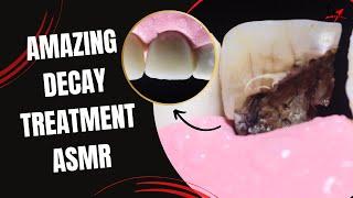 Amazing Dentist Rebuilds Damaged Tooth with Endodontics and Crown | ASMR