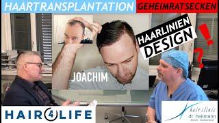 Haartransplantation Geheimratsecken, Haarlinie & Schläfen ► Was man wissen sollte! | Dr. Heitmann