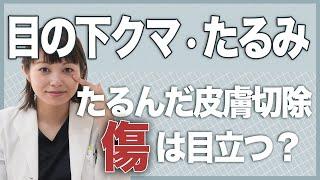 目の下の表側を切開する方必見！たるみたるんだ皮膚切除をした際の傷って目立つ？