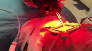 ARTAS Robotic Hair Transplant System Used During Procedure