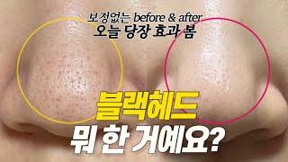 효과 20000% 진짜 확실하게 블랙헤드 없애는 방법 집에서 홈케어로!