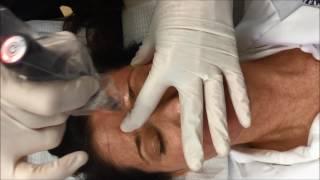 Microneedling with the Collagen P.I.N. Induction Therapy