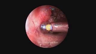 EustaCare- Balloon Eustachian Tuboplasty