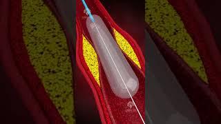 How Does Coronary Angioplasty Work | Blocked Arteries Treatment #shorts - creativelearning3d