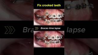 Braces for crooked teeth, transformation before and after #braces #orthodontist #dentist #bracket