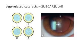 Classification of cataract