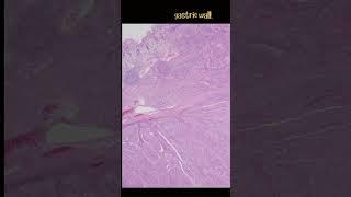 Gastric Squamous Cell Carcinoma