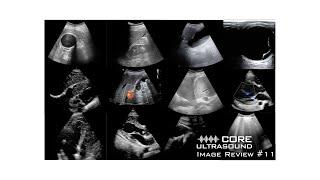 Core Ultrasound Image Review, Episode 11!