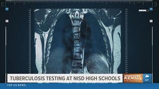 Tuberculosis testing begins this week in Northside ISD