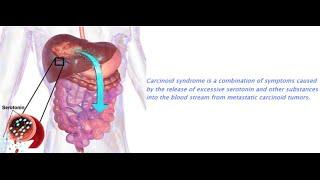 Carcinoid Syndrome