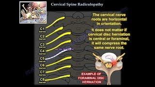 Cervical Radiculopathy - Everything You Need To Know - Dr. Nabil Ebraheim