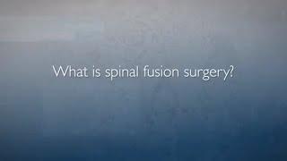 Approaches to Spinal Fusion | FAQ's