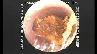 Ordinary cleaning of earwax embolism in the external auditory canal 20250209