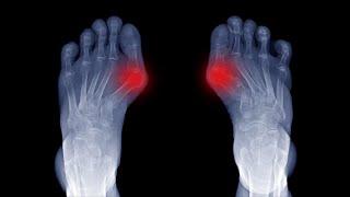 Hallux und Neurodermitis