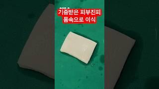 어깨 회전근개파열 이식삽입 [날아라정형외과] #회전근개파열 #어깨통증 #어깨수술
