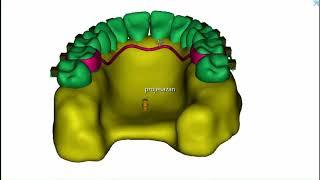 finite element analysis of total arch distalization of maxillary tooth