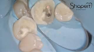 Trattamento endodontico molare inferiore.