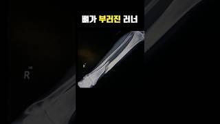 [쟐터뷰 EP.31] 러너에게 골절이 생기면?