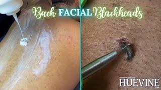 The Back Facial With A Blackened Cyst - Treat Your Bacne, Part 1 | HueVine