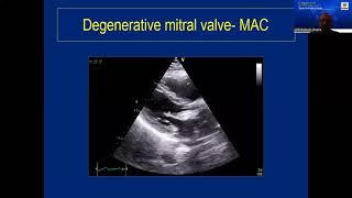 45 course , Mitral Regurgitation , 22 05 2022