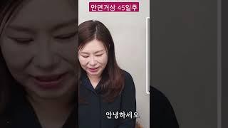 #안면거상후 45일만에 인터뷰 #신의손을찾아서