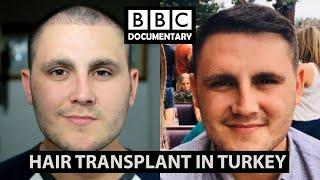 Hair Transplant Turkey - BBC Documentary | Paul Before & After