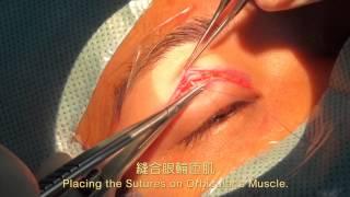 雙眼皮手術 Double Eyelid Surgery，Lid Crease Formation 蕭裕泉醫師 2015.05.22 新眼光眼科診所