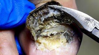 There Is A Green Shell On The Toenails, Be Careful To Remove It【Pedicure Master Lin Jun】