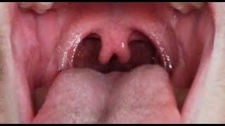 Bifid Uvula - The Dos and Don'ts