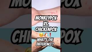 Monkeypox vs. Chickenpox: Know the Difference