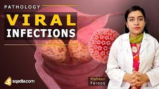 Viral Infections | Mumps | Pathology Video Lectures | Medical V-Learning | sqadia.com