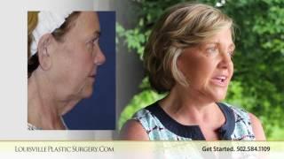 Facelift  necklift tummy tuck denise choosing Dr  O'daniel