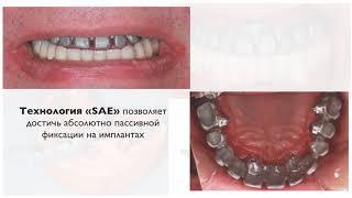 Тотальное восстановление утраченных зубов пациенту "32 Практика"