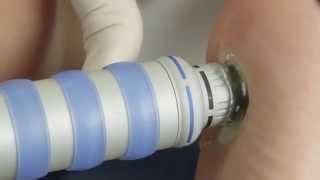 Shockwave Therapy or ESWT Explained