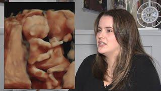 Metro Atlanta woman pregnant with conjoined twins to be induced at Northside Hospital