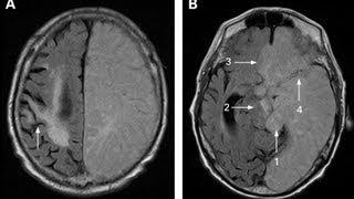 Stroke Turns Man from Gay to Straight