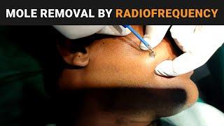 Mole Removal by RF technique #rf #mole #dezireclinic