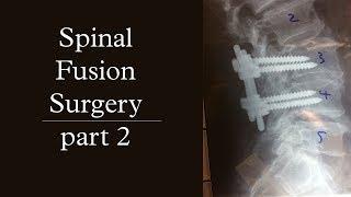 Spinal Fusion Surgery | pt. 2