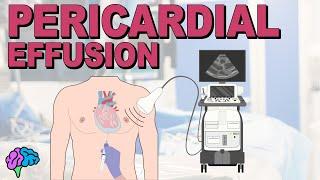 Pericardial Effusion EXPLAINED: What You Need to Know to Recognize, Understand and Treat It!