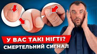 Терміново перевірте це! Як по нігтям виявити ХВОРОБИ! швидка діагностика здоровʼя