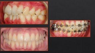 Crazy NON-Extraction Treatment...Orthodontics!!!! Severe Crowding