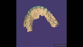 Veneers Case done #exocad