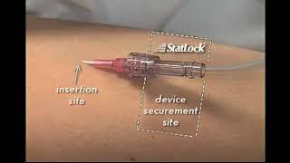 StatLock IV Select Stabilization Device Application Procedure Video