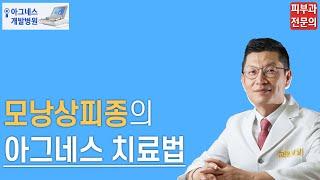 모낭상피종의 아그네스 치료법[아그네스 개발 병원]