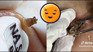 Top 10 Most Satisfying Acne Popping Moments Compilation - Blackheads, Cysts & More!