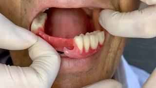 Why flexible dental prosthesis is the best option for you (4K)