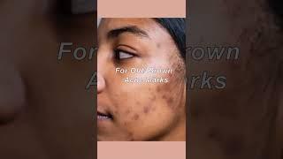 Pharmacy creams for acne marks (more details on  description box ) #facedecor #skincare #shorts