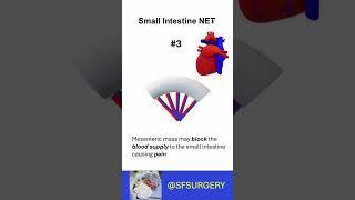 Surgery for small intestine neuroendocrine tumors (SI-NETs or ileum NETs)