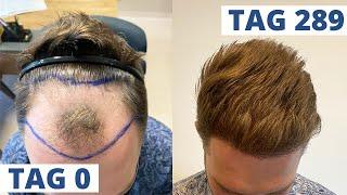 Haartransplantation Vorher Nachher: Zeitraffer 5 Sekunden = 1 Monat